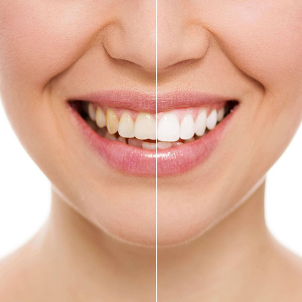 lente-de-contato-dental